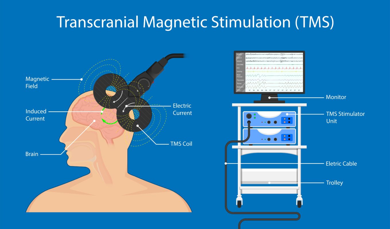 What Are The Differences Between EEG, PEMF, tDCS, TMS, and Binaural Beats? - Neopemf 10